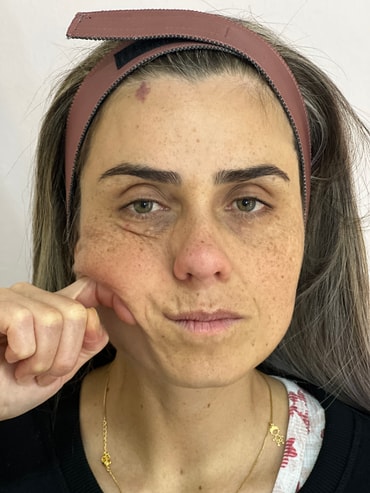 Nuze antes do bioestimulador de colágeno